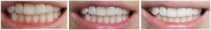 Endlich weiße Zähne